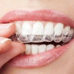 8 Reasons To Consider Getting Dental Braces